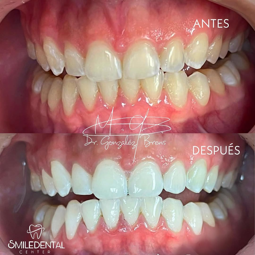 Caso real de ortodoncia en Smile Dental Center