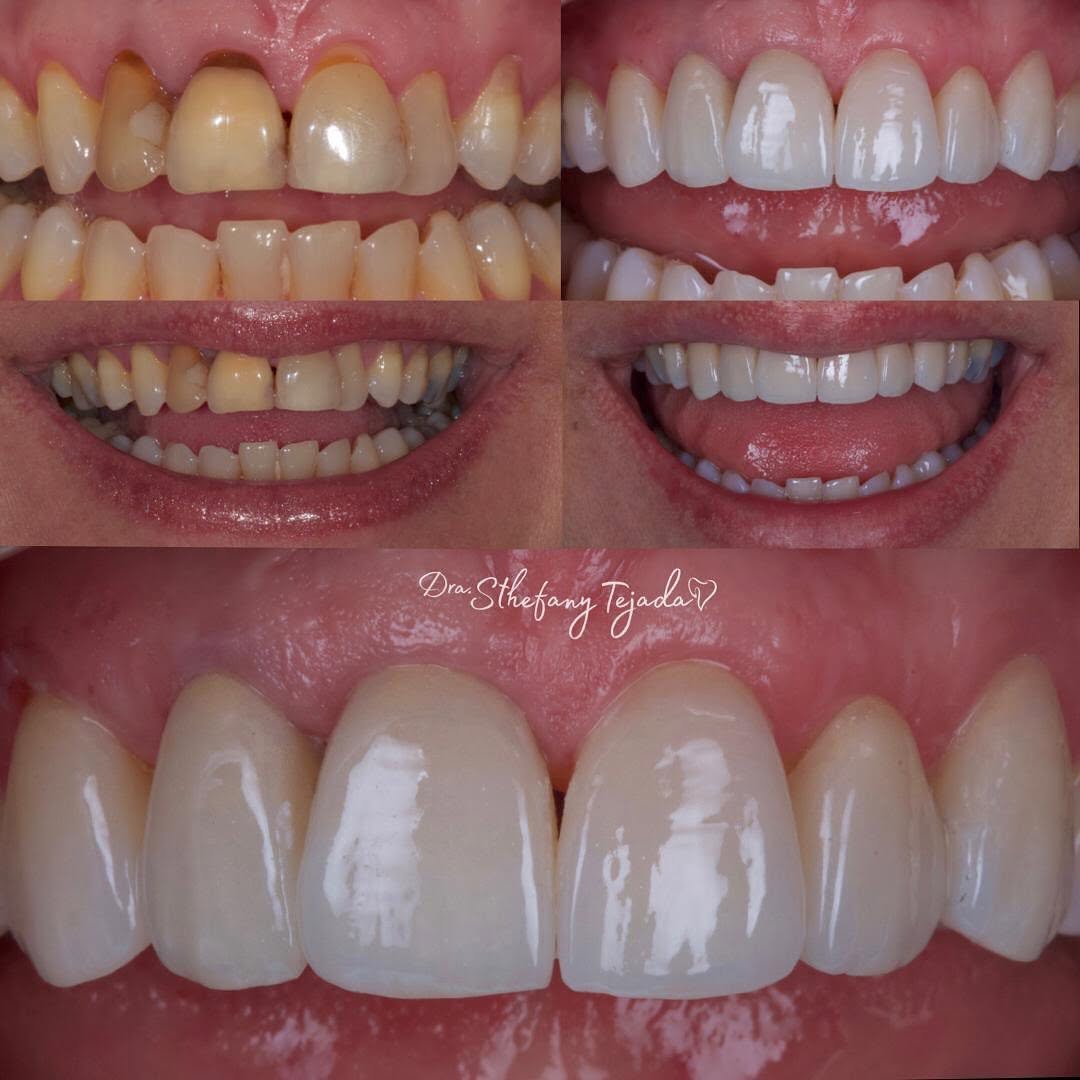 Caso real de carillas en Smile Dental Center