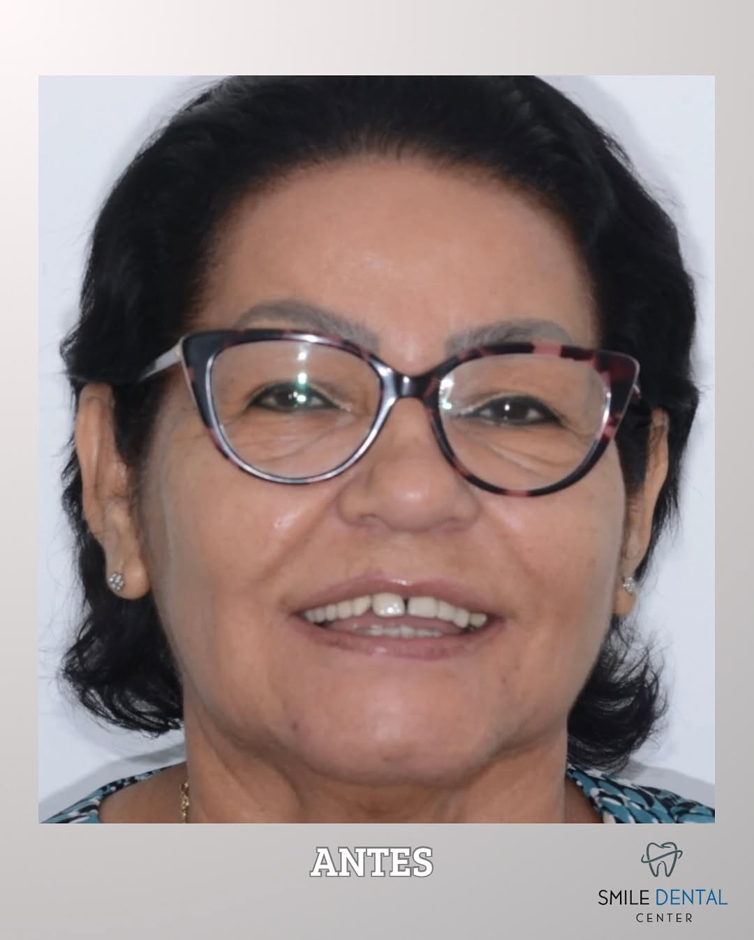 Sonrisa antes del tratamiento