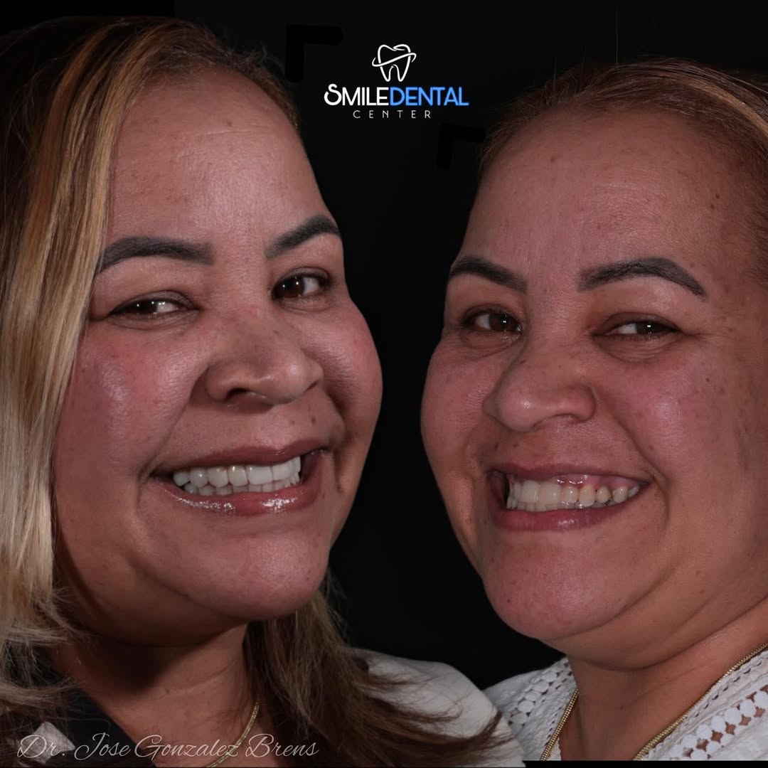 Caso real de diseño de sonrisa en Smile Dental Center