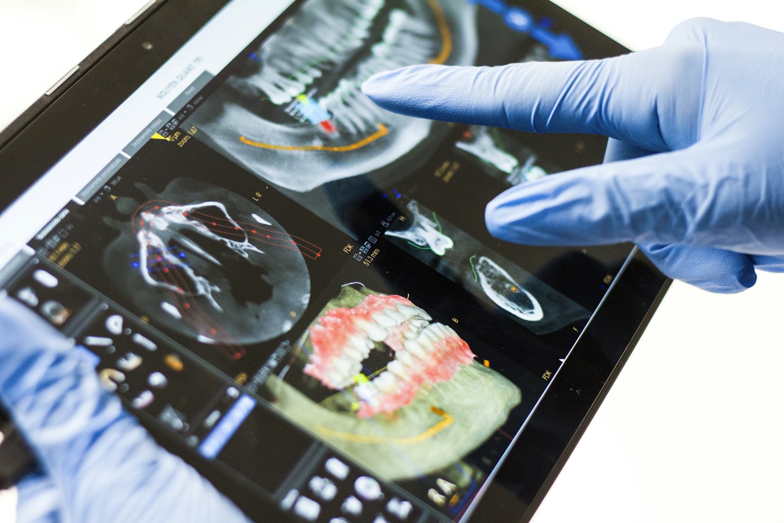 Planificación digital de un implante en Smile Dental Center